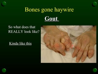 Bones gone haywire   Gout  So what does that REALLY look like?  Kinda like this  