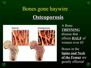 Bones gone haywire   Osteoporosis A Bone  THINNING  disease that effects  HALF  of women over 65 Bones in the  Spine and Neck of the Femur  are greatly effected  
