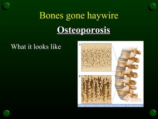 Bones gone haywire   Osteoporosis What it looks like  