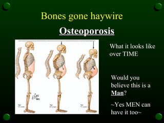 Bones gone haywire   Osteoporosis What it looks like over TIME Would you believe this is a  Man ?  ~Yes MEN can have it too~ 