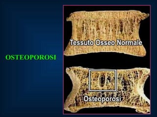 OSTEOPOROSI 