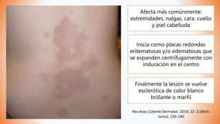 Afecta más comúnmente:
extremidades, nalgas, cara, cuello
y piel cabelluda
Inicia como placas redondas
eritematosas y/o edematosas que
se expanden centrífugamente con
induración en el centro
Finalmente la lesión se vuelve
esclerótica de color blanco
brillante o marfil
Rev Asoc Colomb Dermatol. 2014; 22: 2 (Abril-
Junio), 126-140
 