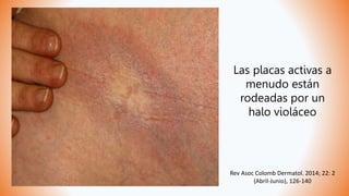 Las placas activas a
menudo están
rodeadas por un
halo violáceo
Rev Asoc Colomb Dermatol. 2014; 22: 2
(Abril-Junio), 126-140
 