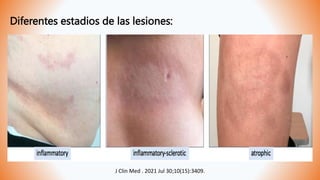 J Clin Med . 2021 Jul 30;10(15):3409.
Diferentes estadios de las lesiones:
 