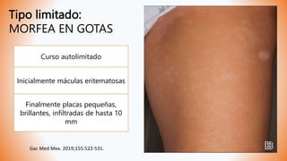 Tipo limitado:
MORFEA EN GOTAS
Curso autolimitado
Inicialmente máculas eritematosas
Finalmente placas pequeñas,
brillantes, infiltradas de hasta 10
mm
Gac Med Mex. 2019;155:522-531.
 