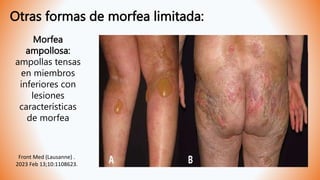 Otras formas de morfea limitada:
Morfea
ampollosa:
ampollas tensas
en miembros
inferiores con
lesiones
características
de morfea
Front Med (Lausanne) .
2023 Feb 13;10:1108623.
 