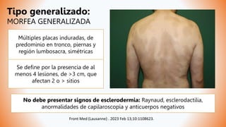 Múltiples placas induradas, de
predominio en tronco, piernas y
región lumbosacra, simétricas
Se define por la presencia de al
menos 4 lesiones, de >3 cm, que
afectan 2 o > sitios
Front Med (Lausanne) . 2023 Feb 13;10:1108623.
No debe presentar signos de esclerodermia: Raynaud, esclerodactilia,
anormalidades de capilaroscopía y anticuerpos negativos
Tipo generalizado:
MORFEA GENERALIZADA
 