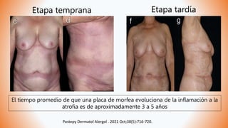 Etapa temprana Etapa tardía
El tiempo promedio de que una placa de morfea evoluciona de la inflamación a la
atrofia es de aproximadamente 3 a 5 años
Postepy Dermatol Alergol . 2021 Oct;38(5):716-720.
 