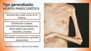 Tipo generalizado:
MORFEA PANESCLERÓTICA
Variante rara, suele iniciar en la
infancia
Distribución cutánea
circunferencial generalizada que
afecta tejido subcutáneo,
músculos y huesos
Resultado: contracturas y grandes
ulceraciones
Front Med (Lausanne) . 2023 Feb 13;10:1108623.
 