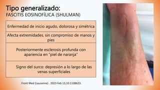 Tipo generalizado:
FASCITIS EOSINOFÍLICA (SHULMAN)
Front Med (Lausanne) . 2023 Feb 13;10:1108623.
Enfermedad de inicio agudo, dolorosa y simétrica
Afecta extremidades, sin compromiso de manos y
pies
Posteriormente esclerosis profunda con
apariencia en “piel de naranja”
Signo del surco: depresión a lo largo de las
venas superficiales
 