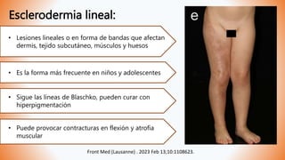 Esclerodermia lineal:
• Lesiones lineales o en forma de bandas que afectan
dermis, tejido subcutáneo, músculos y huesos
• Es la forma más frecuente en niños y adolescentes
• Sigue las líneas de Blaschko, pueden curar con
hiperpigmentación
• Puede provocar contracturas en flexión y atrofia
muscular
Front Med (Lausanne) . 2023 Feb 13;10:1108623.
 