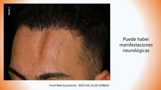 Front Med (Lausanne) . 2023 Feb 13;10:1108623.
Puede haber
manifestaciones
neurológicas
 