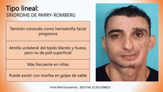 Tipo lineal:
SÍNDROME DE PARRY-ROMBERG
Front Med (Lausanne) . 2023 Feb 13;10:1108623.
También conocido como hemiatrofia facial
progresiva
Más frecuente en niñas
Front Med (Lausanne) . 2023 Feb 13;10:1108623.
Puede existir con morfea en golpe de sable
Atrofia unilateral del tejido blando y hueso,
pero no de piel superficial
 