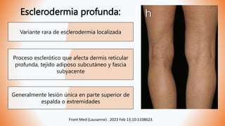 Esclerodermia profunda:
Variante rara de esclerodermia localizada
Proceso esclerótico que afecta dermis reticular
profunda, tejido adiposo subcutáneo y fascia
subyacente
Generalmente lesión única en parte superior de
espalda o extremidades
Front Med (Lausanne) . 2023 Feb 13;10:1108623.
 