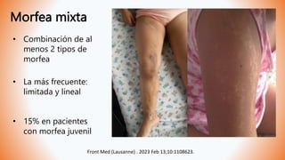 Morfea mixta
Front Med (Lausanne) . 2023 Feb 13;10:1108623.
• Combinación de al
menos 2 tipos de
morfea
• 15% en pacientes
con morfea juvenil
• La más frecuente:
limitada y lineal
 