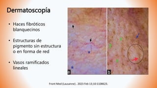Dermatoscopía
• Haces fibróticos
blanquecinos
• Estructuras de
pigmento sin estructura
o en forma de red
• Vasos ramificados
lineales
Front Med (Lausanne) . 2023 Feb 13;10:1108623.
 
