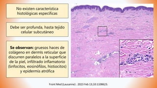 Front Med (Lausanne) . 2023 Feb 13;10:1108623.
No existen característica
histológicas específicas
Debe ser profunda, hasta tejido
celular subcutáneo
Se observan: gruesos haces de
colágeno en dermIs reticular que
discurren paralelos a la superficie
de la piel, infiltrado inflamatorio
(linfocitos, eosinófilos, histiocitos)
y epidermis atrófica
 