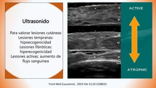 Ultrasonido
Para valorar lesiones cutáneas
Lesiones tempranas:
hipoecogenicidad
Lesiones fibróticas:
hiperecogenicidad
Lesiones activas: aumento de
flujo sanguíneo
Front Med (Lausanne) . 2023 Feb 13;10:1108623.
 