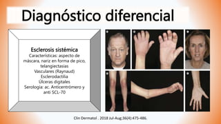 Diagnóstico diferencial
Esclerosis sistémica
Características: aspecto de
máscara, nariz en forma de pico,
telangiectasias
Vasculares (Raynaud)
Esclerodactilia
Úlceras digitales
Serología: ac. Anticentrómero y
anti SCL-70
Clin Dermatol . 2018 Jul-Aug;36(4):475-486.
 