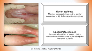 Liquen escleroso
Manchas blancas atróficas en área genital
Aparece en el 6% de los pacientes con morfea
Lipodermatoesclerosis
Se asocia a insuficiencia venosa crónica
Induración circunferencial de la piel en la parte
inferior de la pierna
Clin Dermatol . 2018 Jul-Aug;36(4):475-486.
 