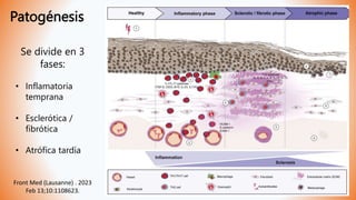 Patogénesis
Se divide en 3
fases:
• Inflamatoria
temprana
• Esclerótica /
fibrótica
• Atrófica tardía
Front Med (Lausanne) . 2023
Feb 13;10:1108623.
 