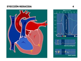 EYECCIÓN REDUCIDA 4