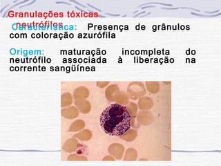 Granulações tóxicas
  neutrófilos
 Característica:    Presença de grânulos
com coloração azurófila
Origem:    maturação     incompleta    do
neutrófilo associada    à liberação    na
corrente sangüínea
 