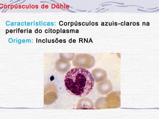 Corpúsculos de Döhle

 Características: Corpúsculos azuis-claros na
 periferia do citoplasma
  Origem: Inclusões de RNA
 