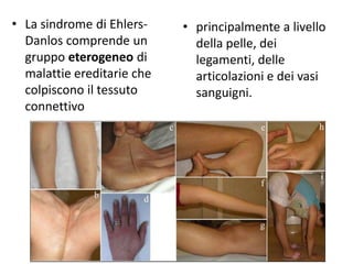 • La sindrome di EhlersDanlos comprende un
gruppo eterogeneo di
malattie ereditarie che
colpiscono il tessuto
connettivo

• principalmente a livello
della pelle, dei
legamenti, delle
articolazioni e dei vasi
sanguigni.

 