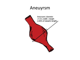 Aneuyrsm 
 