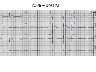 2006 – post MI 
 