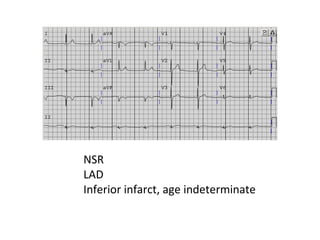 NSR 
LAD 
Inferior infarct, age indeterminate 
 
