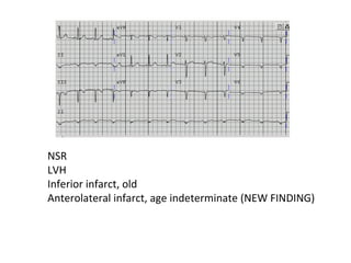 NSR 
LVH 
Inferior infarct, old 
Anterolateral infarct, age indeterminate (NEW FINDING) 
 