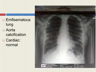  Emfisematous
lung
 Aorta
calcification
 Cardiac:
normal
 