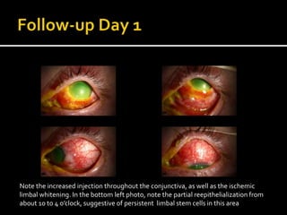 Ocular Chemical Burns - Pathophysiology and Evidence-Based Treatment | PPTX