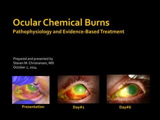 Ocular Chemical Burns 
Pathophysiology and Evidence-Based Treatment 
Prepared and presented by 
Steven M. Christiansen, MD 
October 2, 2014 
Presentation Day#1 Day#6 
 