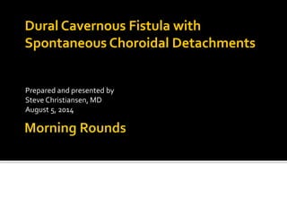 Dural Cavernous Fistula with 
Spontaneous Choroidal Detachments 
Prepared and presented by 
Steve Christiansen, MD 
August 5, 2014 
 