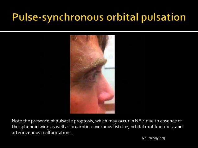 Buzzing In Ear >> Dural cavernous fistula with spontaneous choroidal detachments Buzzing In Ear >> Dural cavernous fistula with spontaneous choroidal detachments