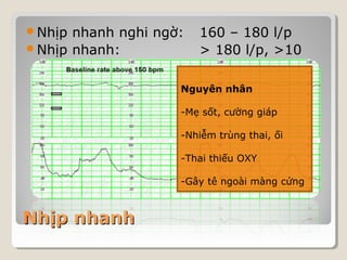 Nhịp nhanh nghi ngờ: 160 – 180 l/p 
Nhịp nhanh: > 180 l/p, >10 
phút 
NNhhịịpp nnhhaannhh 
Nguyên nhân 
-Mẹ sốt, cường giáp 
-Nhiễm trùng thai, ối 
-Thai thiếu OXY 
-Gây tê ngoài màng cứng 
 