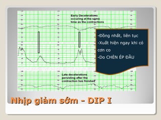 -Đồng nhất, liên tục 
-Xuất hiện ngay khi có 
cơn co 
-Do CHÈN ÉP ĐẦU 
NNhhịịpp ggiiảảmm ssớớmm -- DDIIPP II 
 