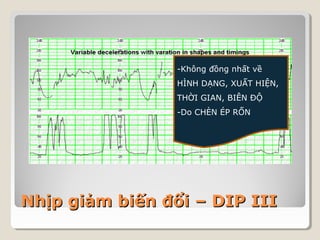 -Không đồng nhất về 
HÌNH DẠNG, XUẤT HIỆN, 
THỜI GIAN, BIÊN ĐỘ 
-Do CHÈN ÉP RỐN 
NNhhịịpp ggiiảảmm bbiiếếnn đđổổii –– DDIIPP IIIIII 
 