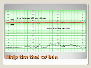 NNhhịịpp ttiimm tthhaaii ccơơ bbảảnn 
 
