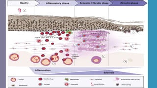 Morphea and allied Sclerosing Inflammatory Dermatoses-1.pptx