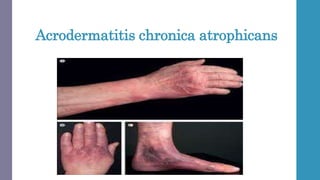 Morphea and allied Sclerosing Inflammatory Dermatoses-1.pptx