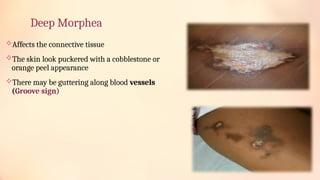 Morphea origin by Dr Okafor Chika Silverline | PPTX