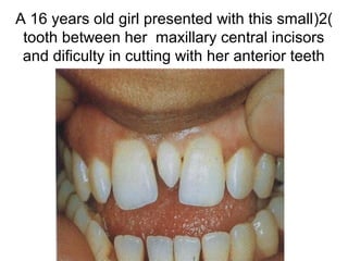 (2(A 16 years old girl presented with this small
tooth between her maxillary central incisors
and dificulty in cutting with her anterior teeth
 