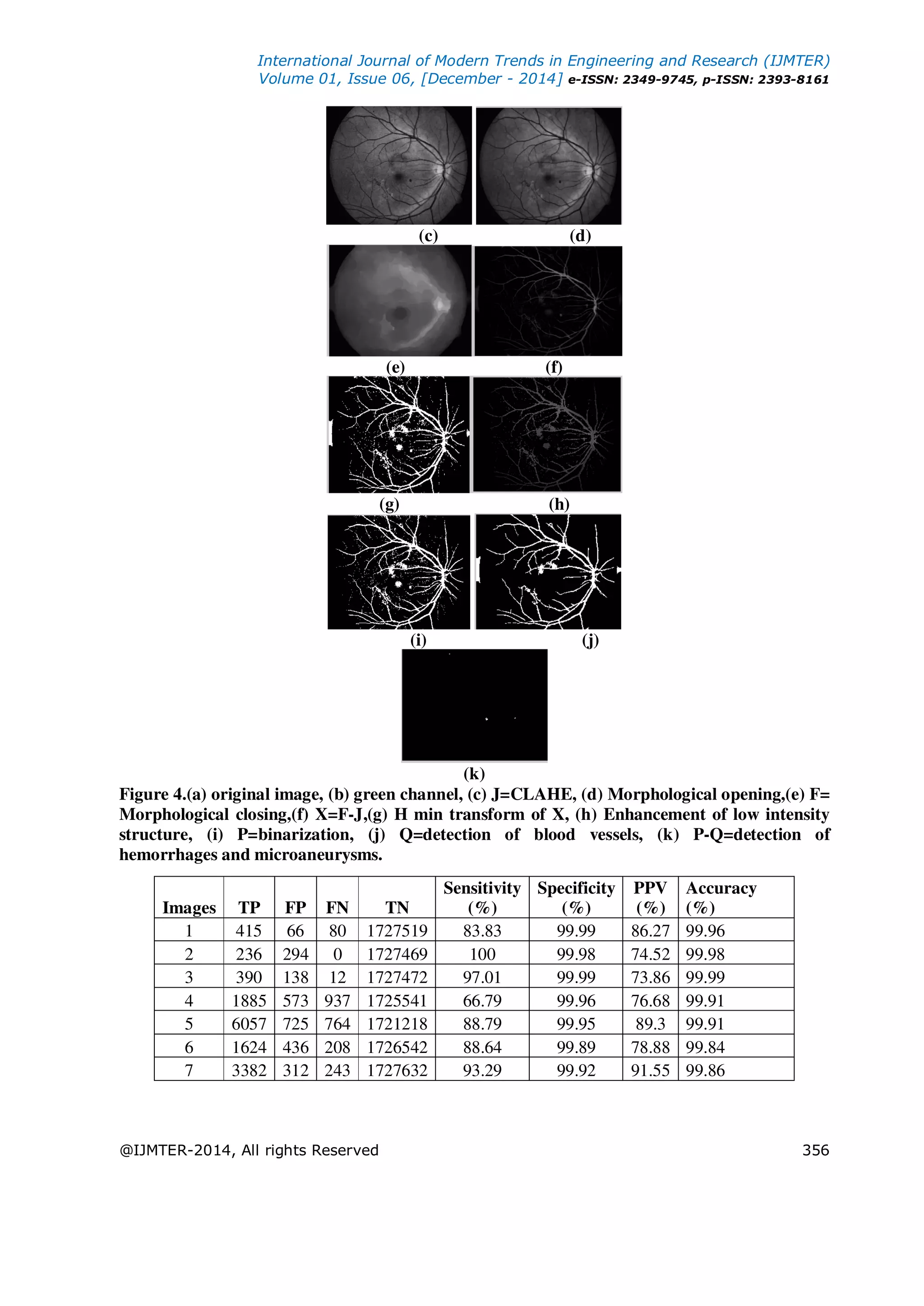 International Journal of Modern Trends in Engineering and Research (IJMTER)
Volume 01, Issue 06, [December - 2014] e-ISSN: 2349-9745, p-ISSN: 2393-8161
@IJMTER-2014, All rights Reserved 356
(c) (d)
(e) (f)
(g) (h)
(i) (j)
(k)
Figure 4.(a) original image, (b) green channel, (c) J=CLAHE, (d) Morphological opening,(e) F=
Morphological closing,(f) X=F-J,(g) H min transform of X, (h) Enhancement of low intensity
structure, (i) P=binarization, (j) Q=detection of blood vessels, (k) P-Q=detection of
hemorrhages and microaneurysms.
Images TP FP FN TN
Sensitivity
(%)
Specificity
(%)
PPV
(%)
Accuracy
(%)
1 415 66 80 1727519 83.83 99.99 86.27 99.96
2 236 294 0 1727469 100 99.98 74.52 99.98
3 390 138 12 1727472 97.01 99.99 73.86 99.99
4 1885 573 937 1725541 66.79 99.96 76.68 99.91
5 6057 725 764 1721218 88.79 99.95 89.3 99.91
6 1624 436 208 1726542 88.64 99.89 78.88 99.84
7 3382 312 243 1727632 93.29 99.92 91.55 99.86
 