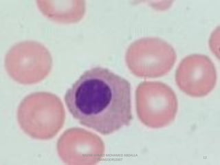 Morphological abnormality of red blood cell | PDF
