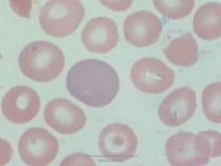 Morphological abnormality of red blood cell | PDF