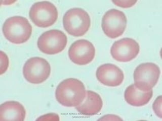 Morphological abnormality of red blood cell | PDF